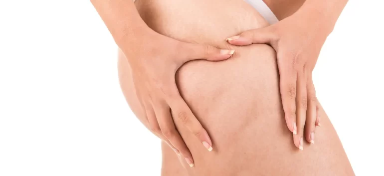 What is Cellulite and am I stuck with it?